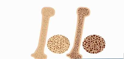 زنگ خطر پوکی استخوان در استان